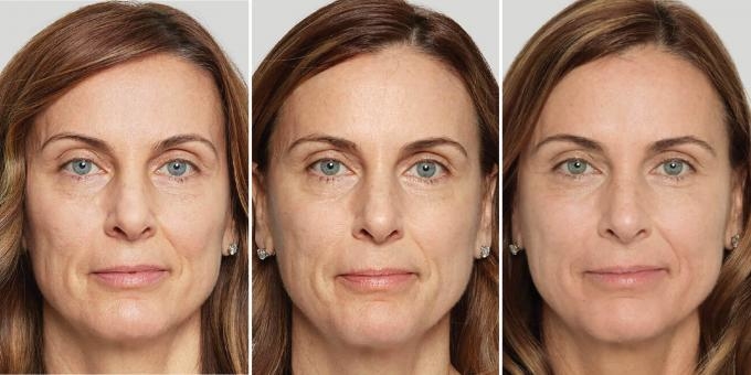 dermal fillerss San Ramon & San Francisco Bay Area | Be CLINICAL