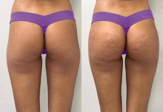 6 dermal fillerss INJECTION SECRETS FROM THE MASTER INJECTOR – The Master Injector