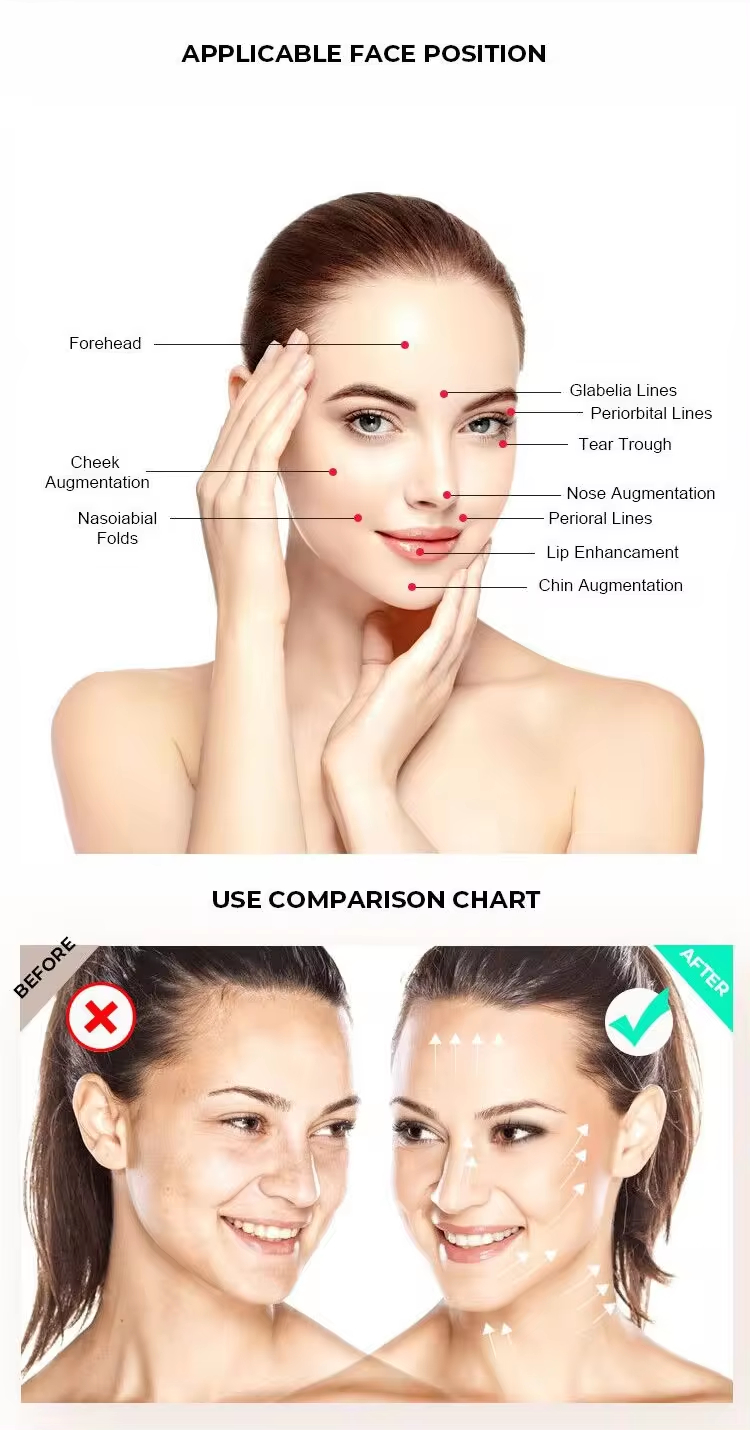 Skin Tightening PDO Hilos 29g 60mm Skin Firming Screw Pdo Thread