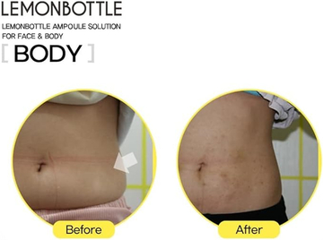 Lemon Bottle Ampoule Solution 5 X 10ml Fat Dissolving Injections